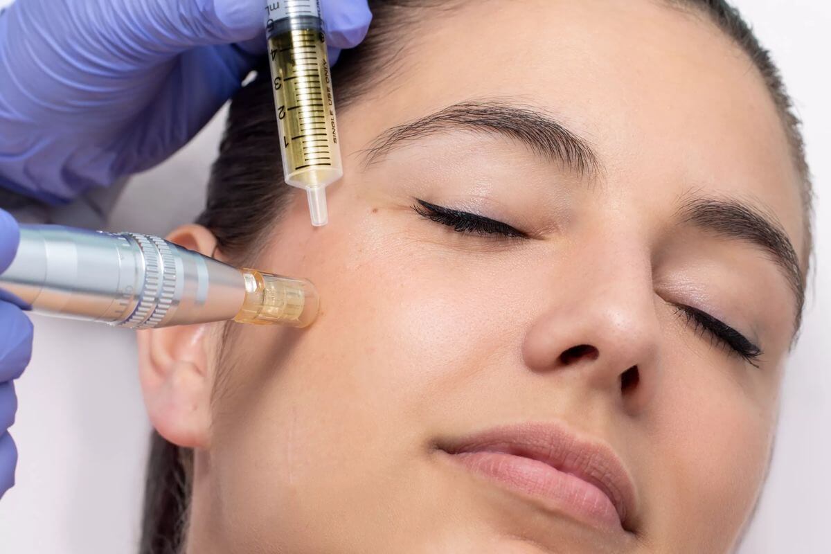 Exosome Microneedling Therapy